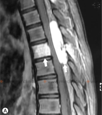 On MRI of the thoracic spinal cord, hemangiomas are visible (indicated by arrows) after administration of a contrast agent.